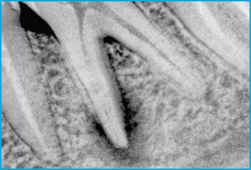 оспалительный процесс, который при фиброзной форме хронического периодонтита чаще всего локализован в апикальной области зуба